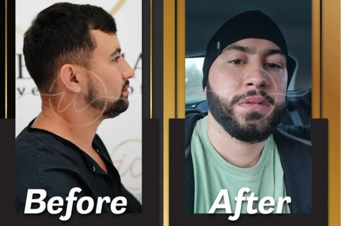 Beard transplant before and after Beard transplant before and after