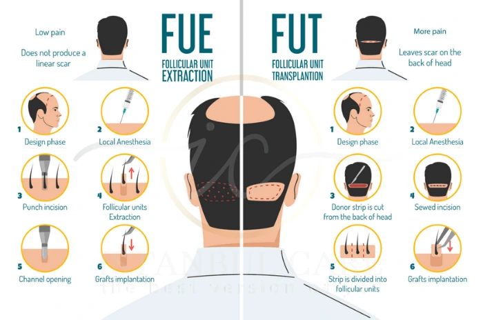 FUE vs FUT hair transplant