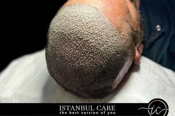 FUT hair transplant