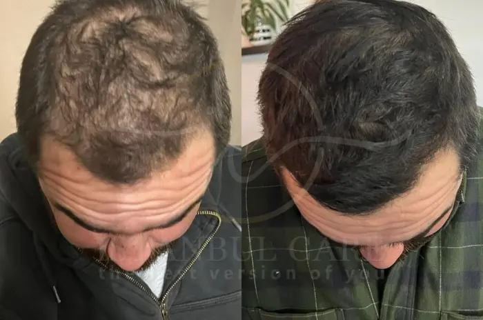 Finasteride results timeline Finasteride results timeline