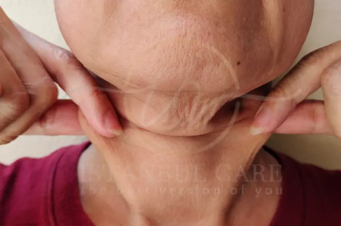 Fix saggy facial skin after weight loss Fix saggy facial skin after weight loss