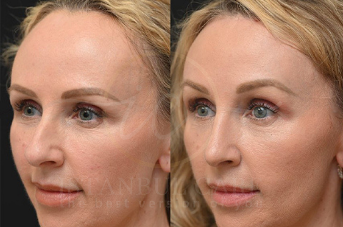 Forehead-Surgery-vs-hair-transplant-_1_ Forehead-Surgery-vs-hair-transplant