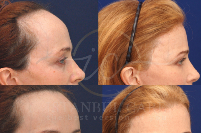 Forehead-reduction-surgery Forehead reduction surgery