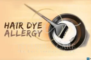 hair dye allergy treatment tips