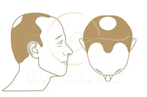 Hair Loss