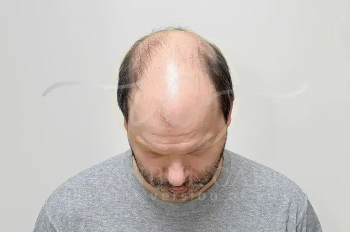 _Hair Loss and Treatment Options