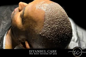 Hair Restoration