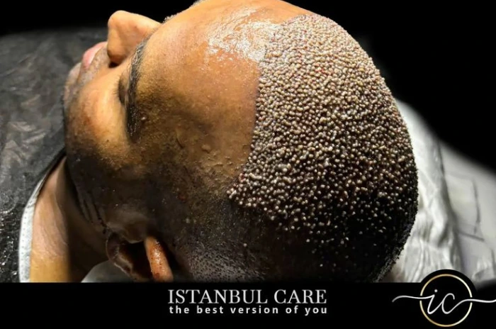 Hair transplants