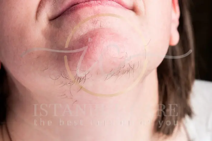 Hirsutism in Women Causes