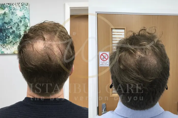 İstanbul care-Cómo detectar y tratar precozmente la calvicie de la coronilla