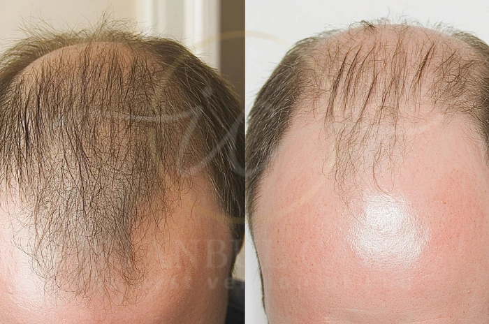 Male Baldness Top Causes,