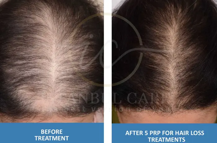 Prp treatment Prp treatment