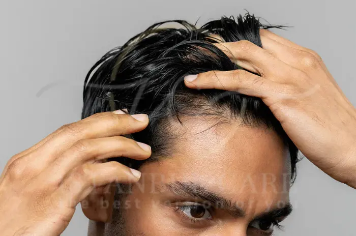 Signs, Causes & Differences from Balding