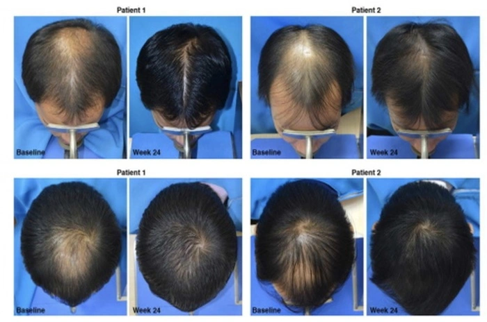 Finasteride and Minoxidil combination Finasteride and Minoxidil combination