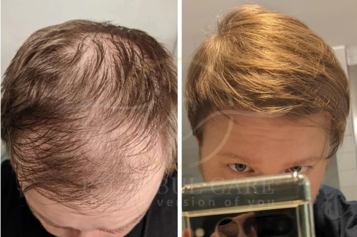 hair loss causes hair loss causes