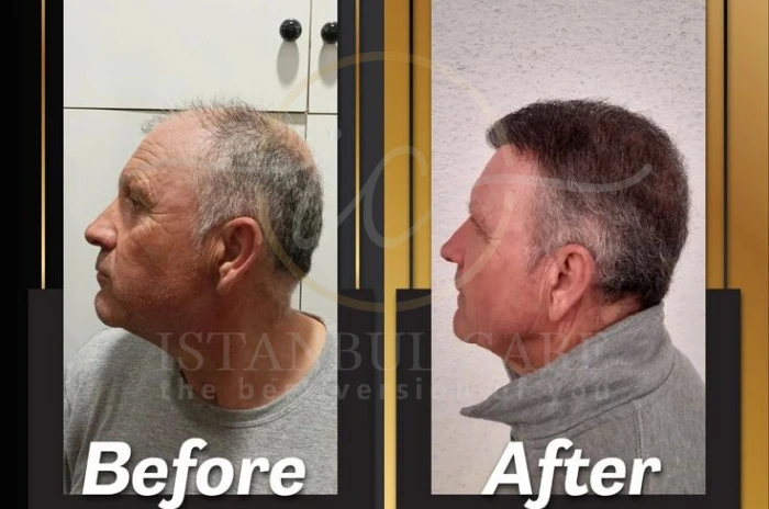 hair transplant recovery