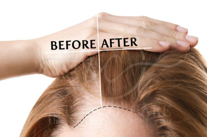 hairline-hair-transplant