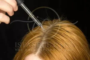 Levothyroxine Hair Loss Treatment