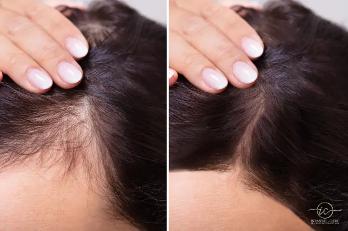 vitamin d deficiency hair loss_ vitamin d deficiency hair loss