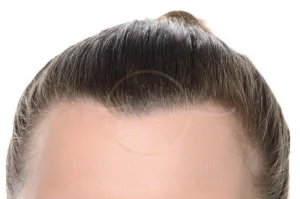 widow’s peak causes myths