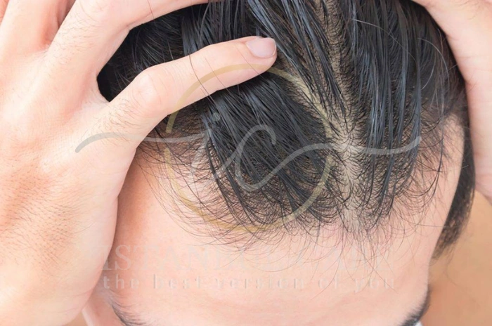 Cause hair loss (2) Cause hair loss