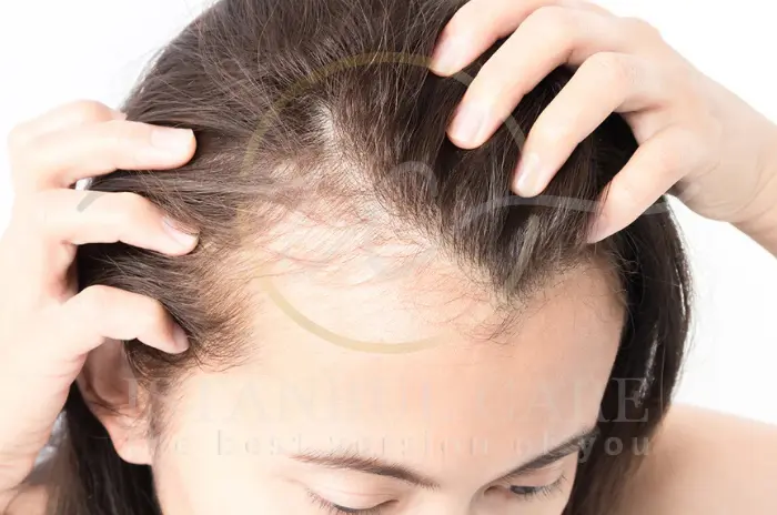 Does Mounjaro Cause Hair Loss