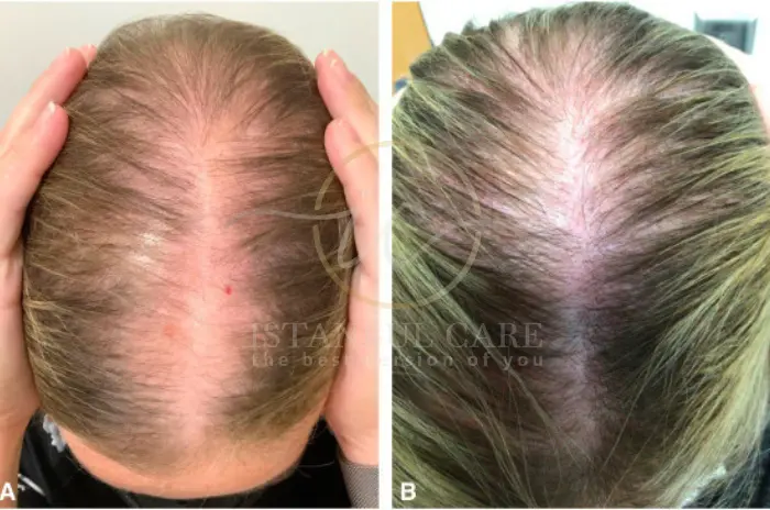 Female hair loss hormones Female hair loss hormones