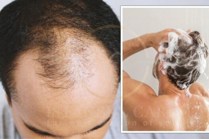 Hair loss shampoo Hair loss shampoo