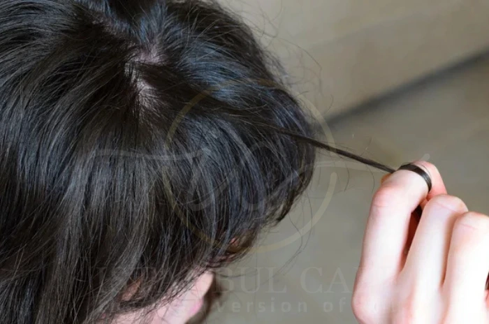 Hair pulling disorder Hair pulling disorder