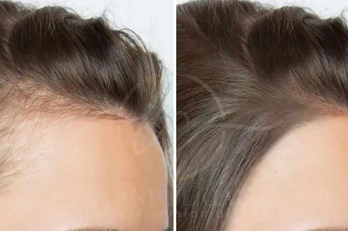Hair thinning in women
