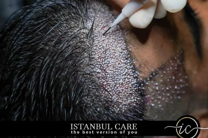 Hair transplant Hair transplant