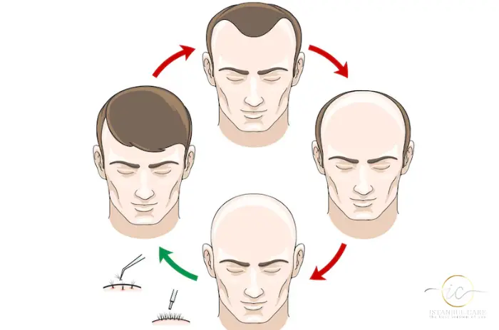 High testosterone hair loss High testosterone hair loss