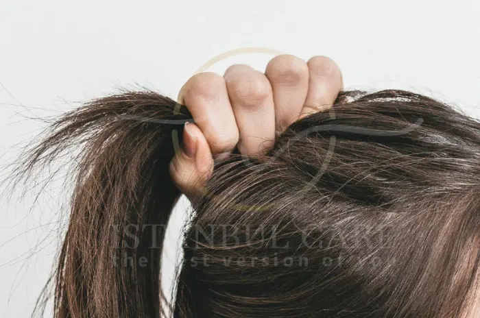 How to treat traction alopecia How to treat traction alopecia