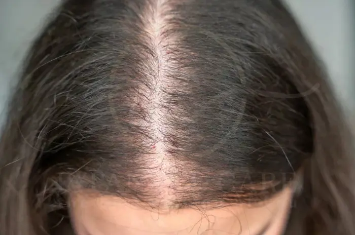 traction alopecia vs pattern baldness