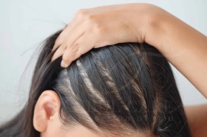 Key Differences Between Traction Alopecia and Pattern Hair Loss (2)