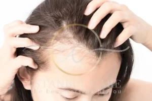 Postpartum hair regrowth