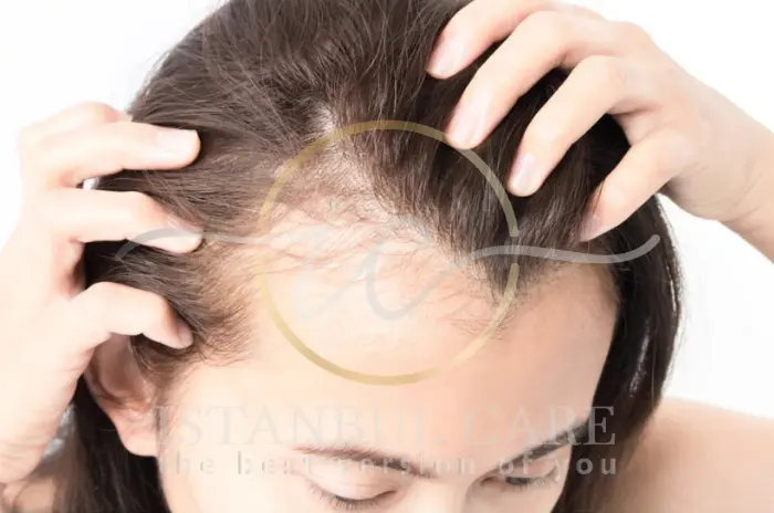 Postpartum hair regrowth