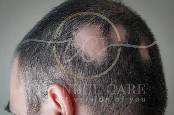 Radiation-Induced Hair Loss and Regrowth