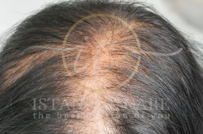 Radiation-Induced Hair Loss