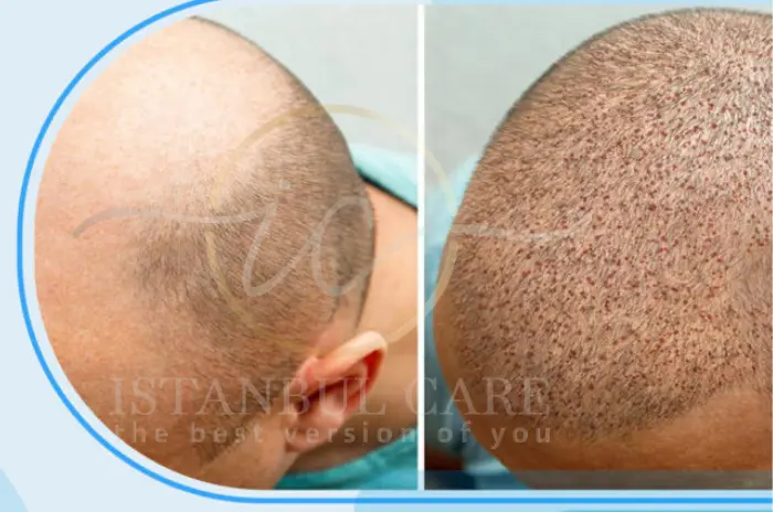 Stem cell Stem cell