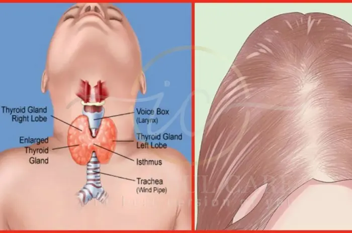 Thyroid treatment for hair loss