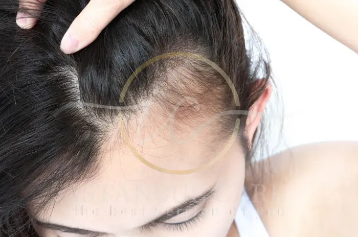 Traction alopecia Traction alopecia