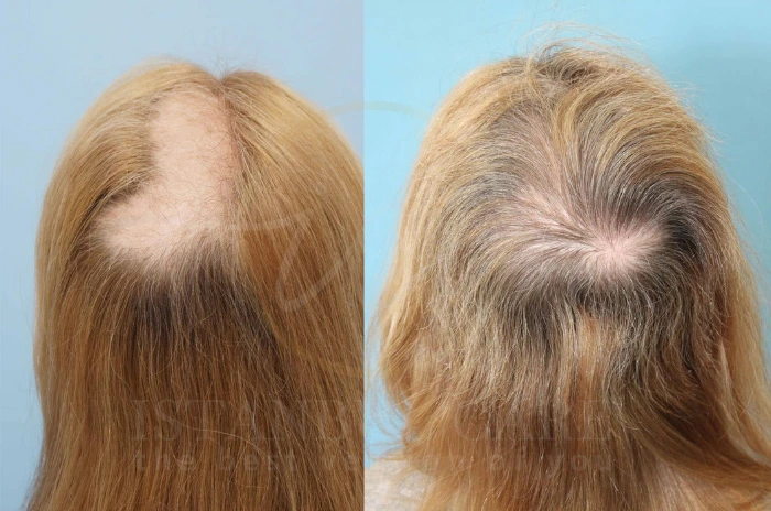 Trichotillomania treatment Trichotillomania treatment