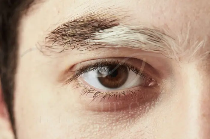Vitiligo Hair Causes Symptoms and Treatment Options