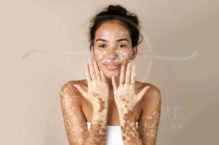 Vitiligo Hair Causes and Symptoms
