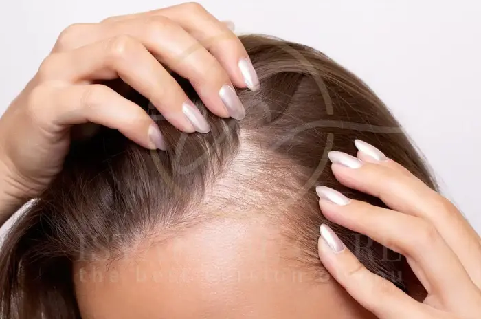 Which Hormone Causes Hair Loss in Women (1)