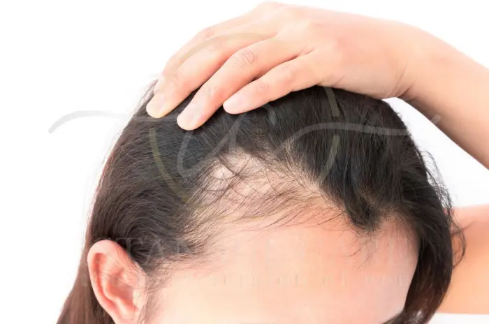 Which Hormone Causes Hair Loss in Women