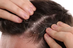 can dandruff cause hair loss