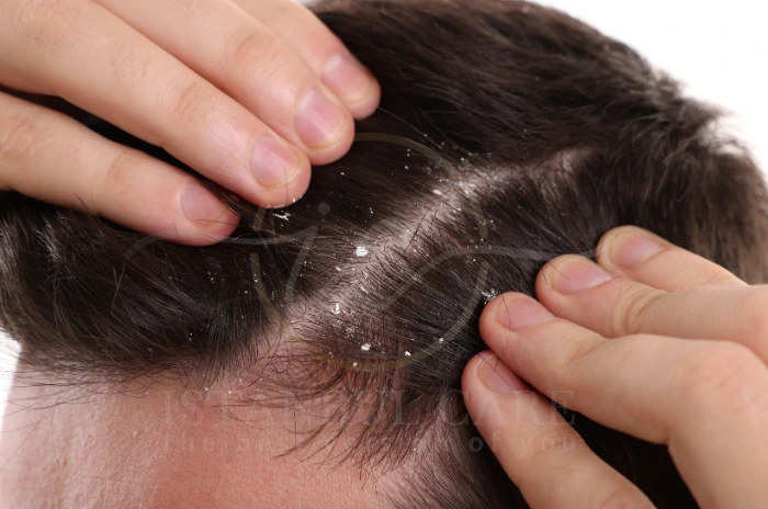 can dandruff cause hair loss