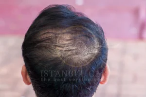 chronic telogen effluvium